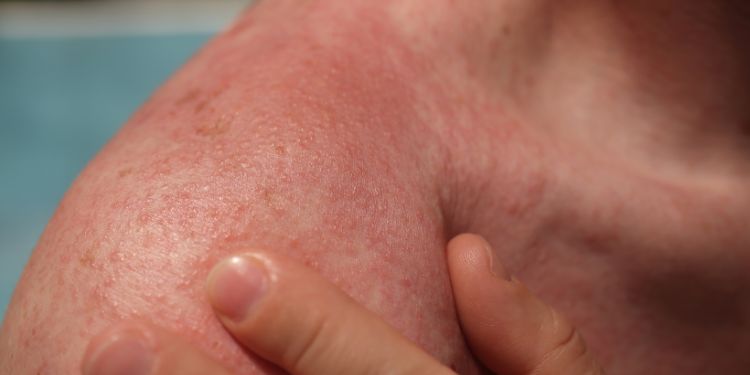 tipuri de fotodermatoza, care sunt cauzele si factorii de risc pentru fotodermatoza, simptome fotodermatoza, optiuni de tratament pentru fotodermatoza, sfaturi pentru a preveni fotodermatoza