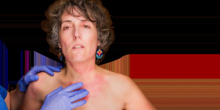 Eczema: tipuri, cauze, manifestări clinice și soluții