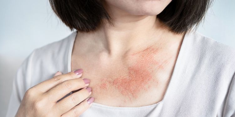 ce este eczema, tipuri de eczema, de ce apare eczema, ce poate declansa un puseu de eczema, cauze eczema, simptome eczema, cum este diagnosticata eczema, ce solutii exista pentru eczema, tratament eczema, cum reduci riscul unor noi episoade de eczema, eczema cand trebuie sa mergi la dermatolog,