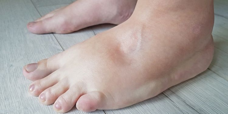 Remedii naturiste pentru picioare umflate